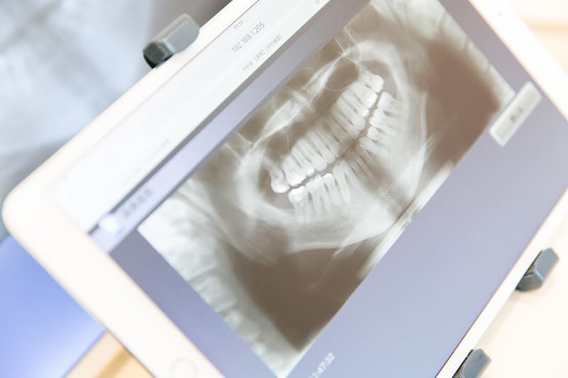 高知県　高知市　アポロニア歯科クリニック　サージカルガイドを使った高精度のインプラント治療